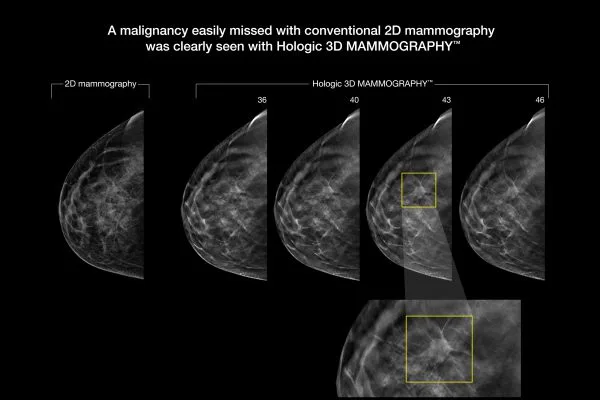 3-D mammograms now available in the Verde Valley