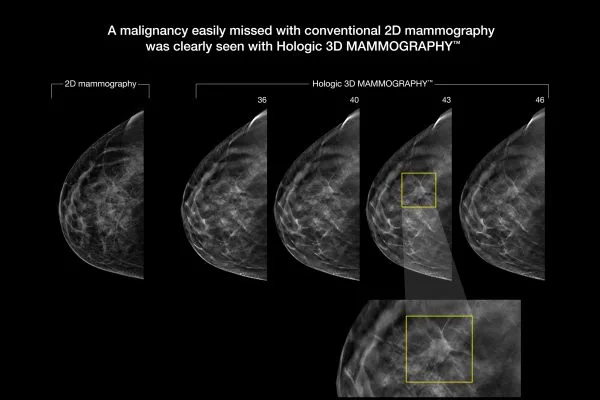 Mammogram