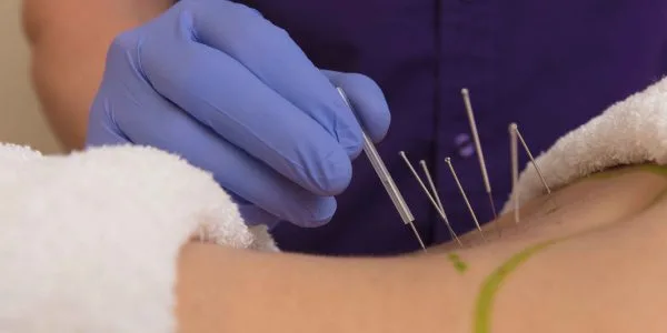 Can dry needling technique help you?