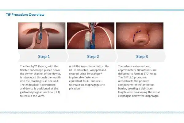 New incisionless surgery to treat heartburn is available at Verde Valley Medical Center